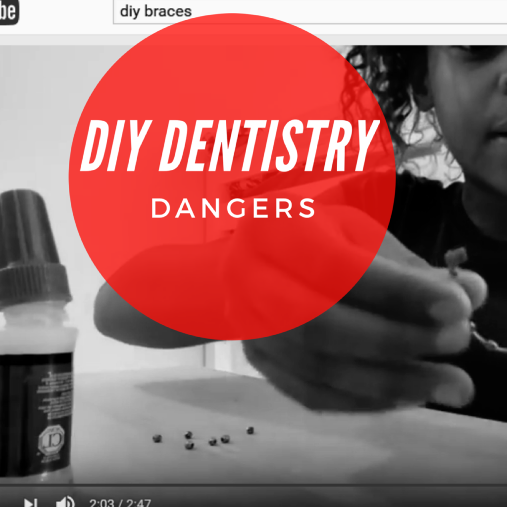 Diy dentistry — Go Smile Pediatric Dentistry & Orthodontics, Pinellas Park, FL