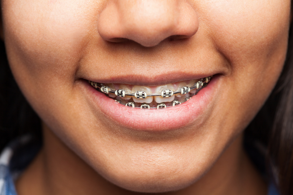 Comprehensive orthodontic treatment with traditional braces