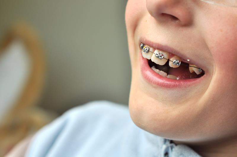 Early interceptive orthodontic treatment with braces for a child