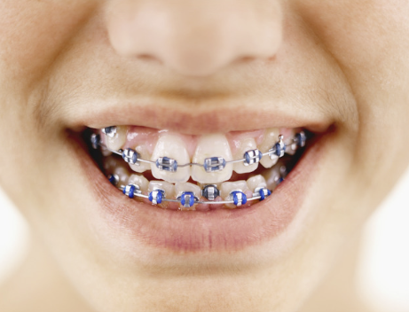 Braces — Go Smile Pediatric Dentistry & Orthodontics, Pinellas Park, FL